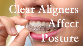 Clear aligners influence posture which Minster chiropractic helps.