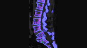 Minster Chiropractic Center is aware that inflammatory spinal gout is a differential diagnosis to consider for patients who present with back pain and other spine related symptoms.