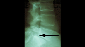 Minster spondylolisthesis 