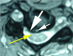 active inflammation in the cervical spine disc