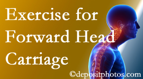 Minster chiropractic treatment of forward head carriage is two-fold: manipulation and exercise.